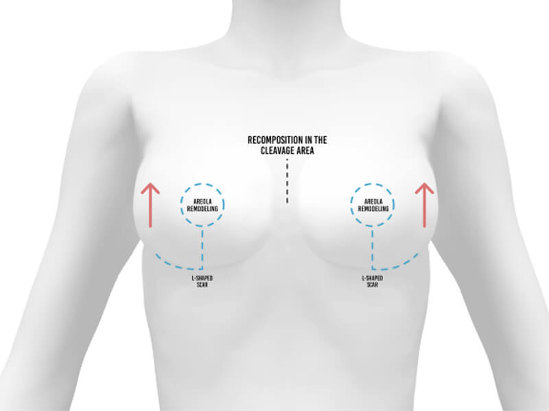 img-breast-lift-surgery