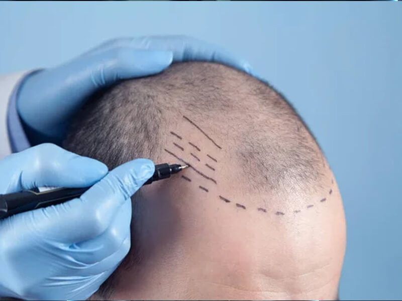 img-hair-transplant