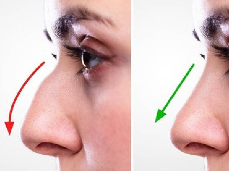 img-nose-reshaping